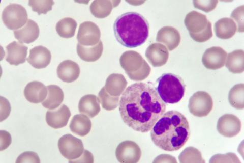 Leukemia