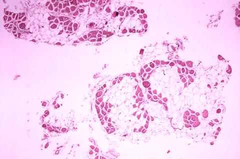 Duchenne