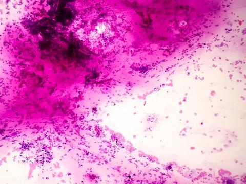 cancer pancreas