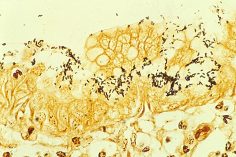 helicobacter pylori