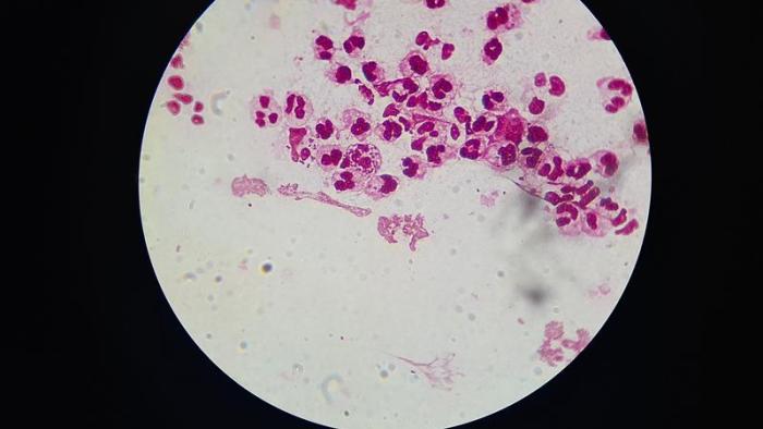 Phase 3 trial shows efficacy of new antibiotic against gonorrhoea bacteria