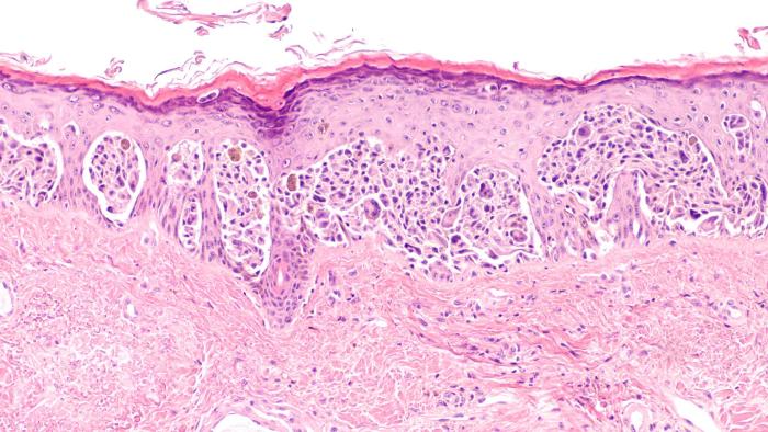 melanoma