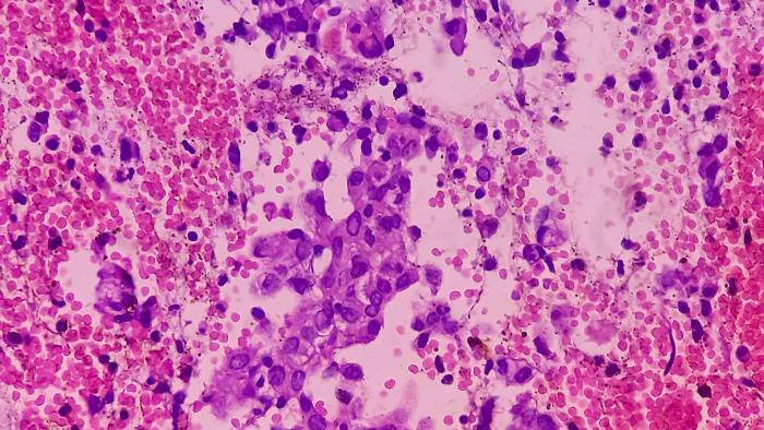 cáncer de endometrio